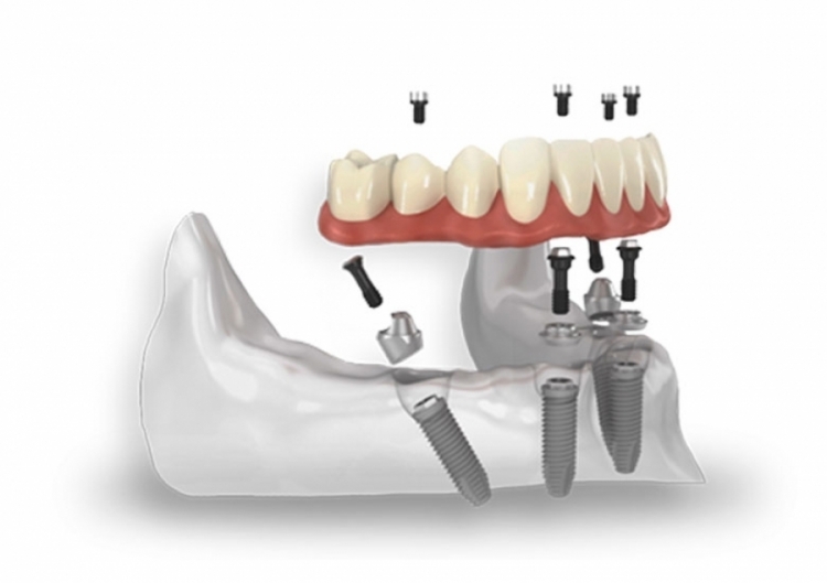 All on 4™ - tutti su quattro impianti - centro dentale dr Goran Slivar Croazia