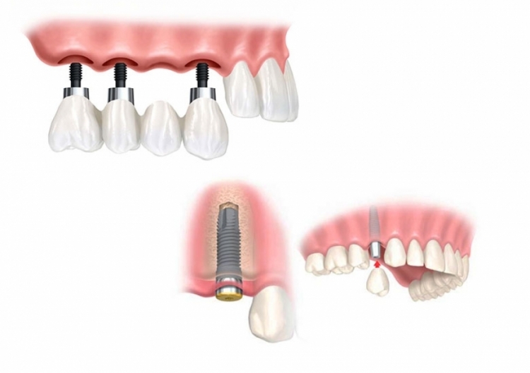 Ponti e corone su impianti presso il centro impianti dentali a vite dr goran slivar croazia