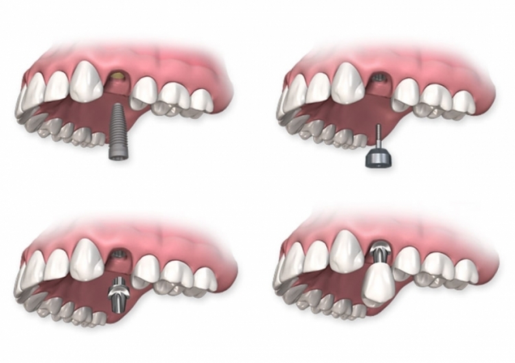 Risarcimento del dente singolo - prezzi - dentista croato