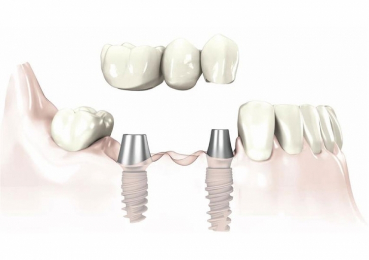 Aggiornamento protesi dentarie - centro impianti dentali - migliori prezzi dentisti in Croazia