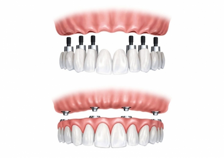tutti su 6 impianti dentali - clinica dentale croata dr.goran slivar