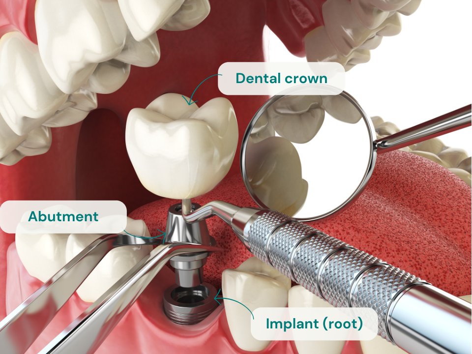 Parti di impianti dentali - procedura