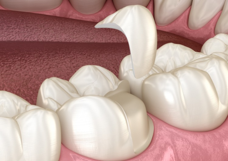 inlay overlay odontoiatrico - clinica odontoiatrica croata-dr.goran-slivar-cro inlay overlay odontoiatrico - clinica odontoiatrica croata-dr.goran-slivar-cro