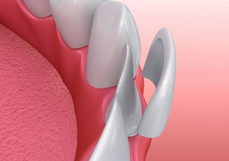 Faccette dentali - croatia dental centar Faccette dentali - croatia dental centar