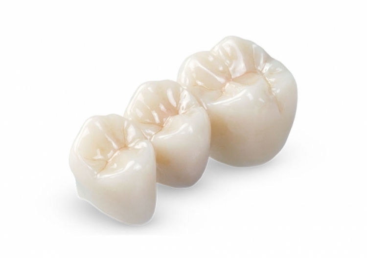 Sostituzione dei denti - Corona in ceramica non metallica - dental centar croatia goran slivar Sostituzione dei denti - Corona in ceramica non metallica - dental centar croatia goran slivar