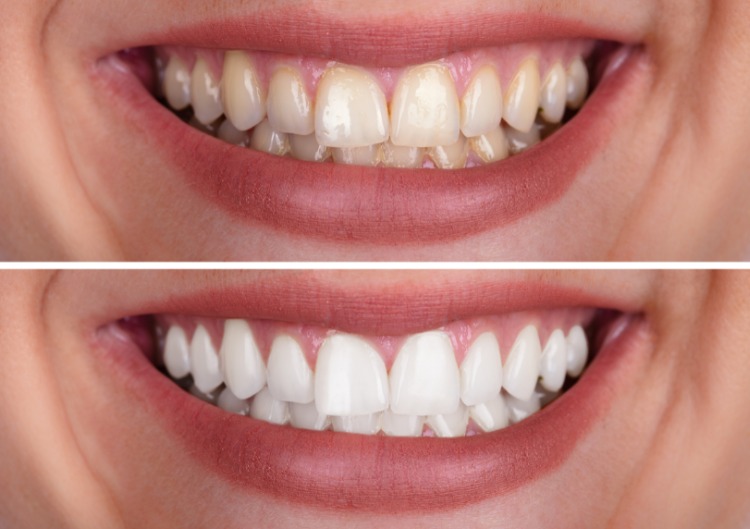 risultati dello sbiancamento dei denti - centro impianti dentali croato risultati dello sbiancamento dei denti - centro impianti dentali croato