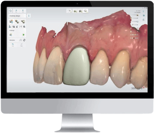 3shape scanner digital protocol
