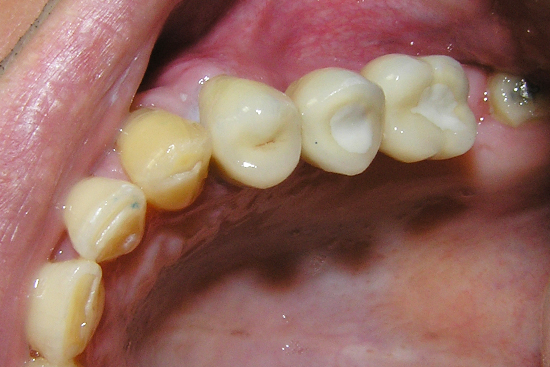 otturazione dei canali radicolari e conservazione dei denti mediante otturazione in composito e sostituzione dei denti estratti con impianti nella mascella superiore