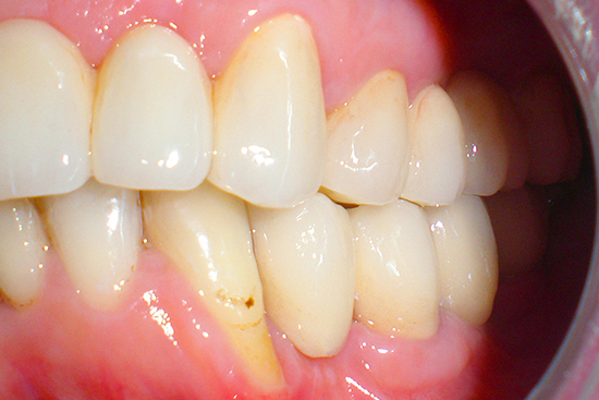 otturazione dei canali radicolari e conservazione dei denti mediante otturazione in composito e sostituzione dei denti estratti con impianti nella mascella superiore